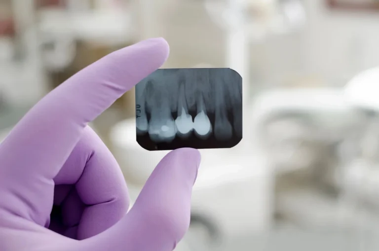Porcelain dental crown being fitted on a model tooth