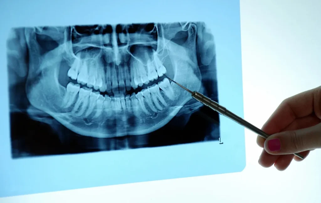Dental X-ray showing a tooth after root canal treatment