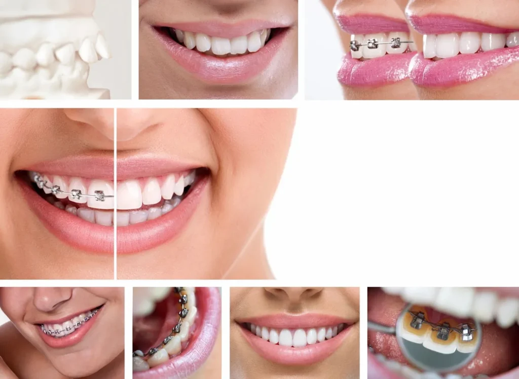 Patient holding a clear Invisalign aligner
