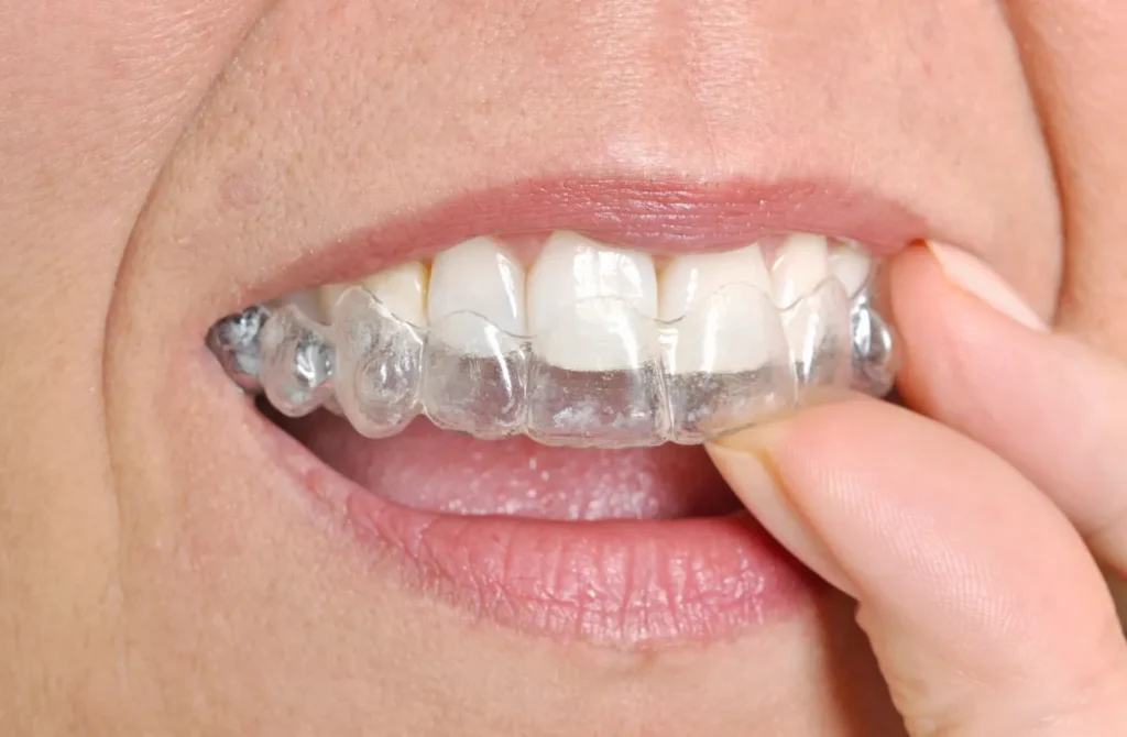 Custom clear night guard for teeth grinding